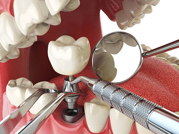 Best Emergency Wisdom Teeth Removal in Noroton, CT